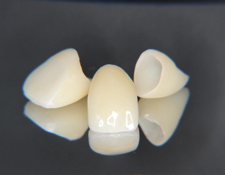 詰め物・被せ物