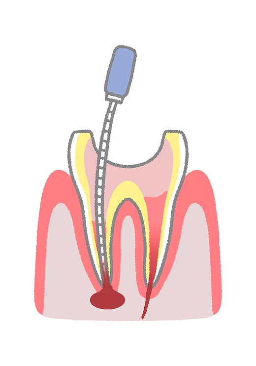 感染した神経や血管を除去