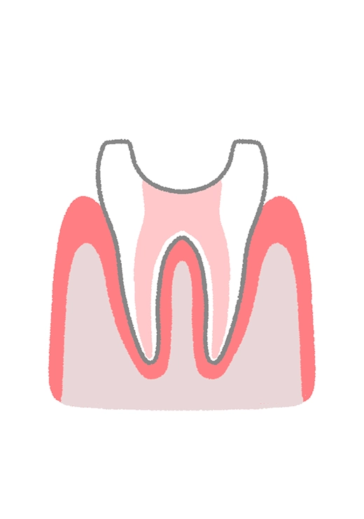 根管の乾燥と密封
