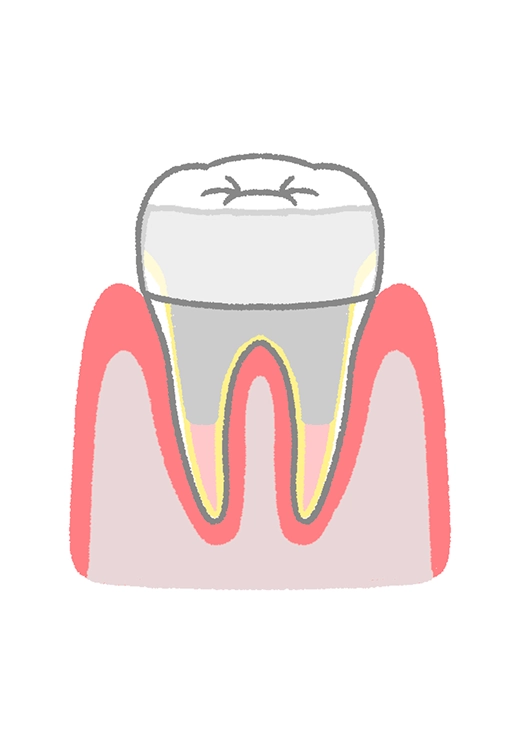 歯冠修復（クラウン・インレーなど）