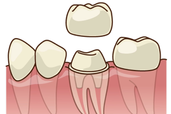 歯冠修復（クラウン・インレーなど）