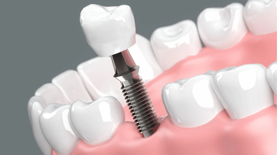 インプラント治療