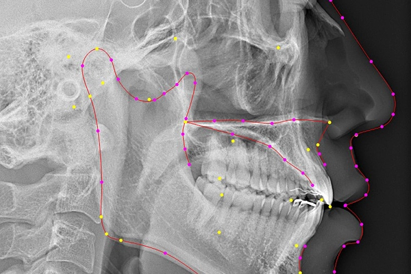 セファロ分析による将来の成長を見据えた矯正計画