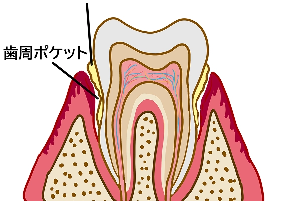 歯周ポケット検査