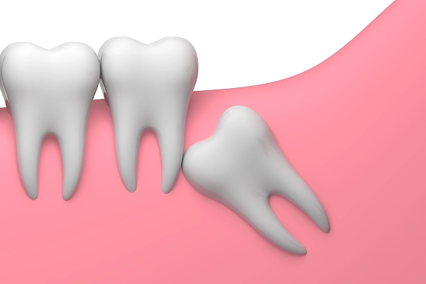 骨に埋まった完全埋伏の親知らずにも対応